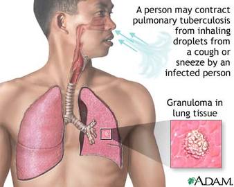 List  Of Diseases That Affect The Lungs