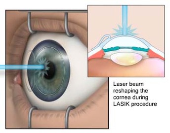 Should I Get Laser Eye Surgery?