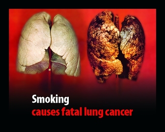 How Does Lung Cancer Manifested in the Body