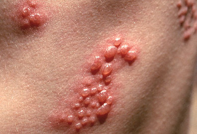  How To Protect Yourself From Shingles Diseases 