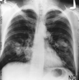 How Does Lung Cancer Manifested in the Body