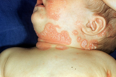 Symptoms Of Skin Diseases (with Pictures)