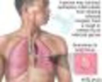  Treatment Of  Tuberculosis Like Diseases!
