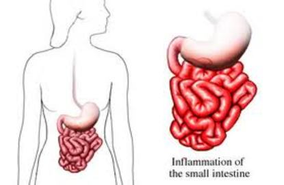 How to treat inflammatory bowel diseases
