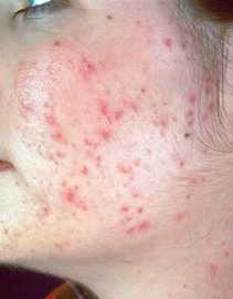 How To Use Homeopathic Means To Get Rid Of Acne