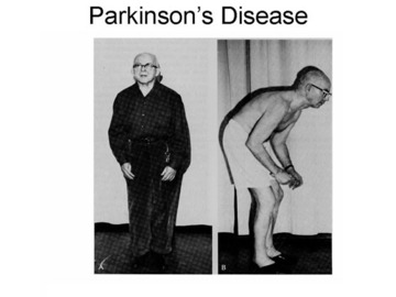   How To Protect Yourself From Parkinsons Diseases	