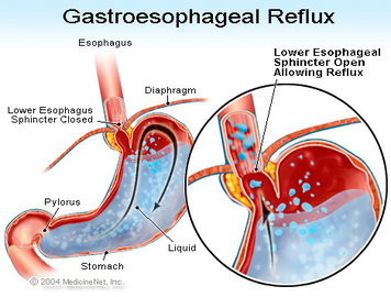 How To Protect Yourself From Acid Reflux Diseases	