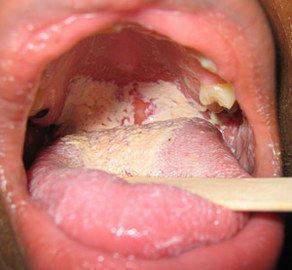 Does An Oral Yeast Infection Cause a Cottony Feeling in the Mouth?
