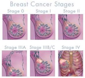 What Is the Final Stage Of Breast Cancer?