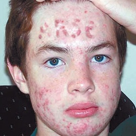 Where Can I Find Pictures Of Acne