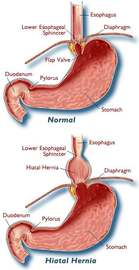 What Are The Symptoms Of Irritable Bowel Diseases