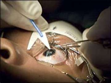 Corrective Surgery For Better Vision