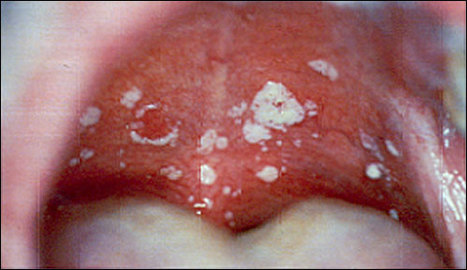 Does An Oral Yeast Infection Cause a Cottony Feeling in the Mouth?