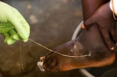 Signs And Symptoms Of Guinea Worm Disease