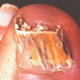 How To Prevent Nail Diseases Pictures	