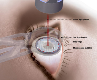 What Is the Average Laser Eye Surgery Cost?