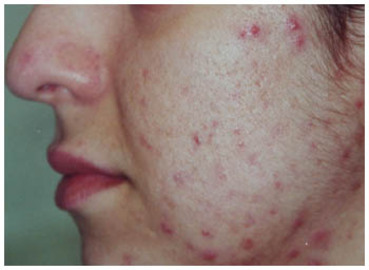 Symptoms Of Skin Diseases (with Pictures)