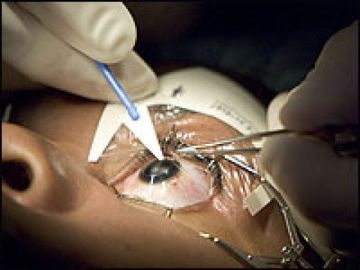 Should I Get Laser Eye Surgery?