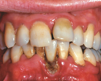 Oral Diseases That Are Preventable