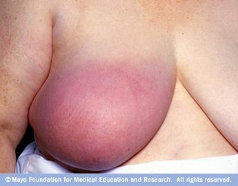 Common Symptoms Of Breast Cancer