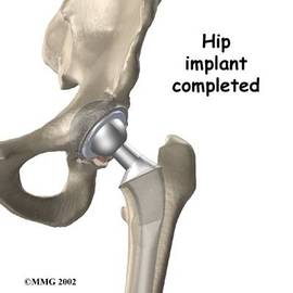 Is Hip Replacement Surgery Dangerous?