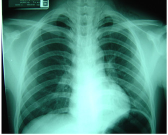 Chest Diseases That Are Life Threatening