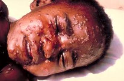 5 Common Signs Of Diseases In Africa	