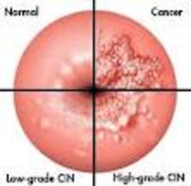 Symptoms Cervical Cancer