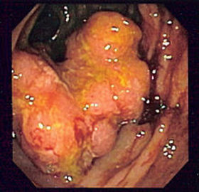 Symptoms Of Crohn's Diseases