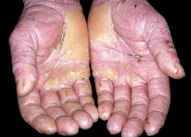 Symptoms Of Skin Diseases (with Pictures)