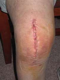 About Surgery For a Knee Replacement