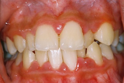 Are Periodontal Diseases Avoidable?