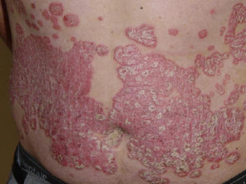 How To Prevent Psoriasis Skin Diseases	