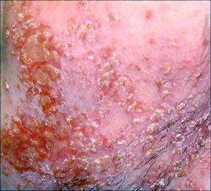 Remedies Of Fungal Diseases	(images)