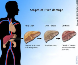 About Rapid Liver Diseases Or Ldps