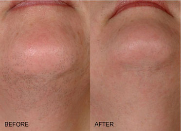 How Laser Hair Removal Works