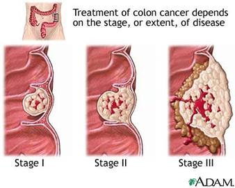 About Each Cancer Stage