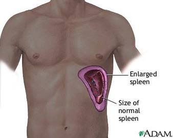 How To Protect Yourself From Spleen Diseases 