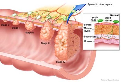 What To Take For Cancer Pain