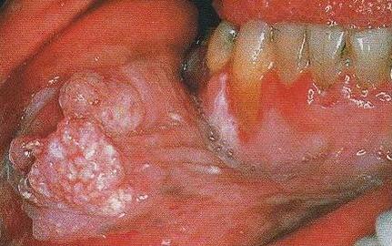 Does Chewing Tobacco Cause Cancer Of the Month
