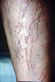 How To Know If You Have Diseases Scabies