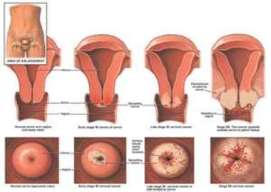 Common Signs Of Cervical Cancer