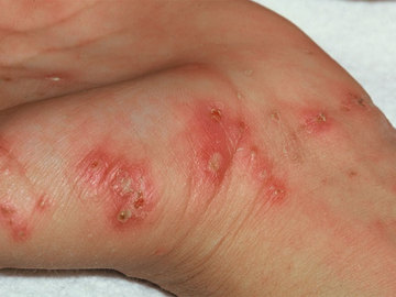 What you need to know about fomite scabies treatment