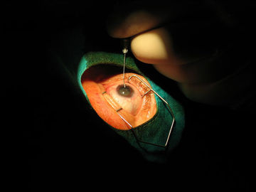 Corrective Surgery For Better Vision