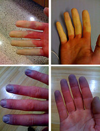 Why is raynaud's diseases dangerous for childrens