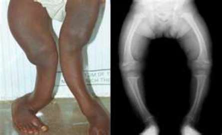 About Bone Diseases And Conditions That Affect Children