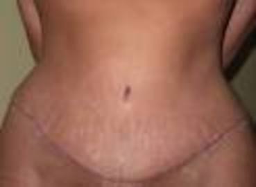 What Are the Risks Of a Tummy Tuck Surgery?