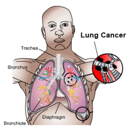 the Survial Rate Of Stage 4 Lung Cancer
