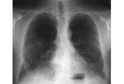 Risk Factors For Occupational Lung Diseases