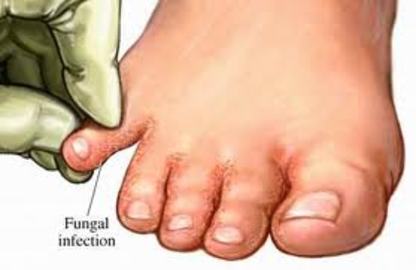 Remedies Of Fungal Diseases	(images)